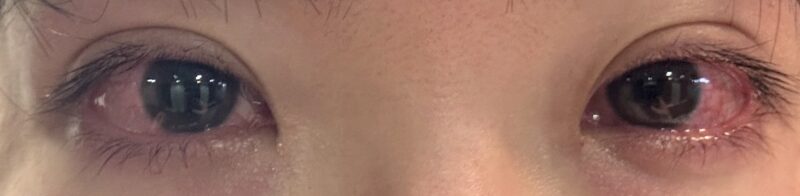 ICL手術直後の眼の写真