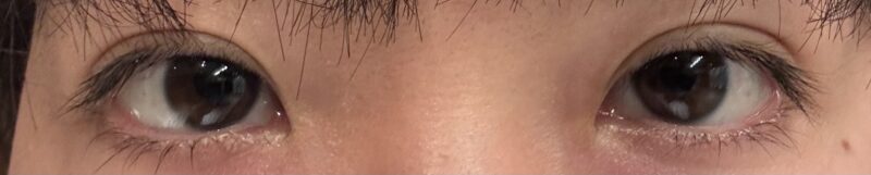 ICL手術1週間後の眼の写真