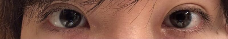 ICL手術1ヶ月後の眼の写真